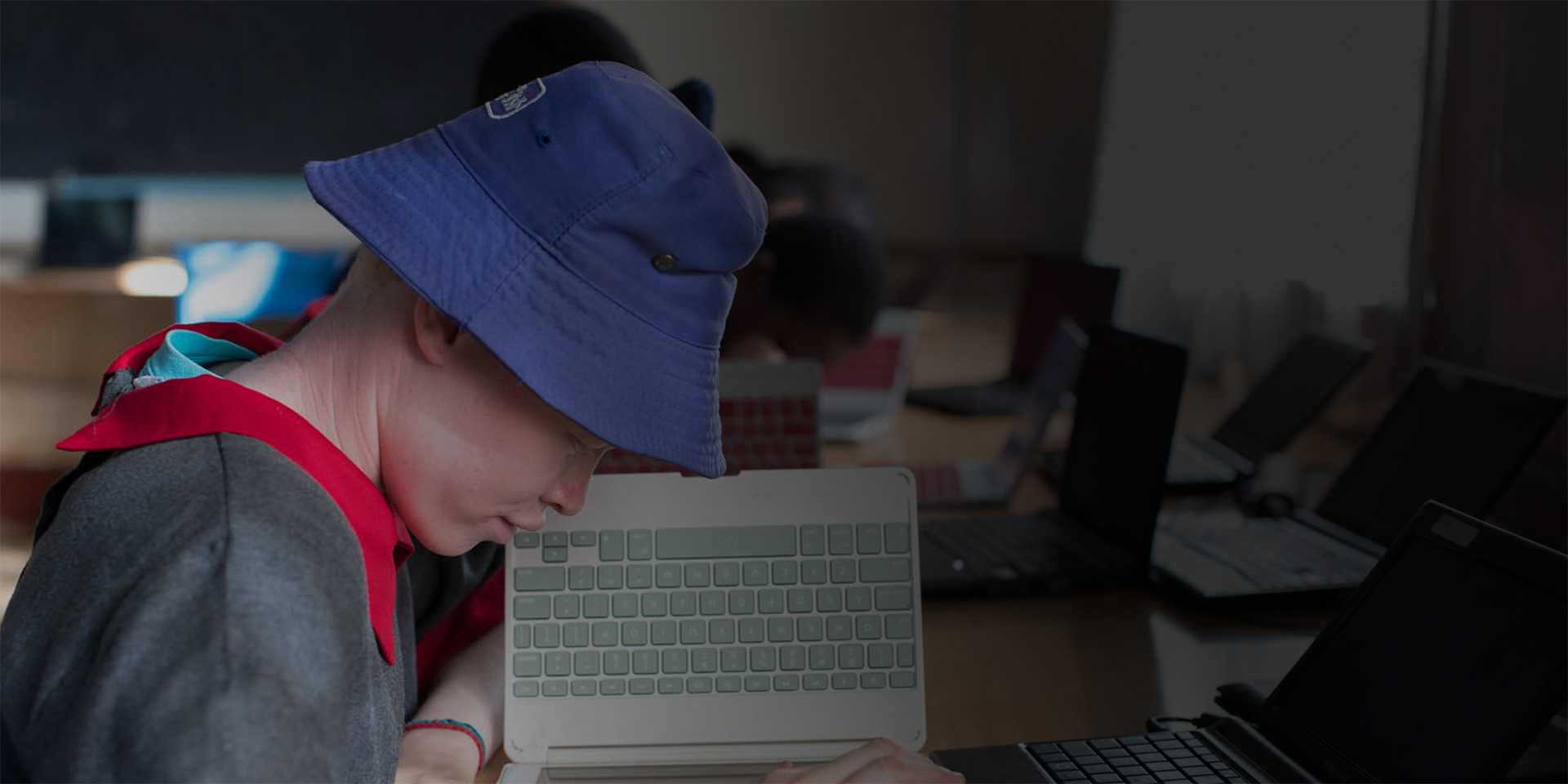 albinism boy using laptop